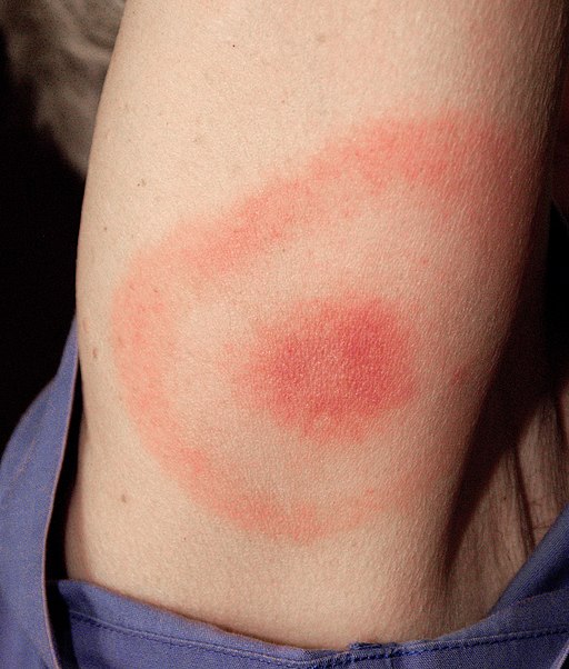 Erythema_migrans_-_erythematous_rash_in_Lyme_disease_-_PHIL_9875