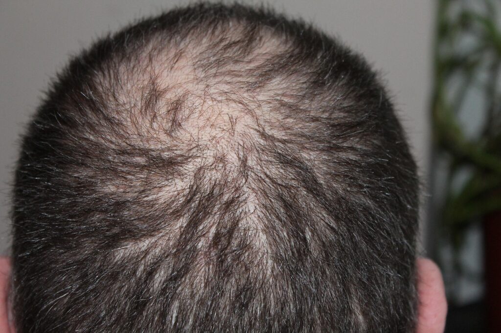 hair, man, hair loss, head, hair loss, hair loss, hair loss, hair loss, hair loss